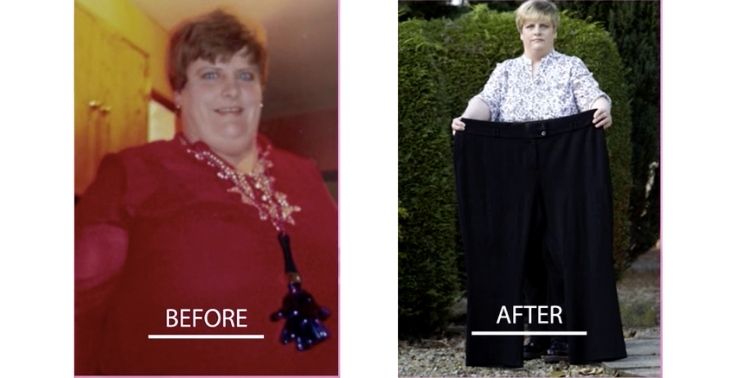 Virtual Gastric Band Before and After Photo 3