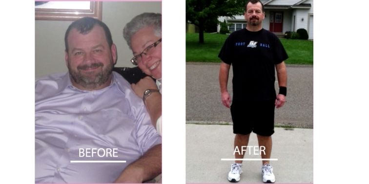 Virtual Gastric Band Before and After Photo 1